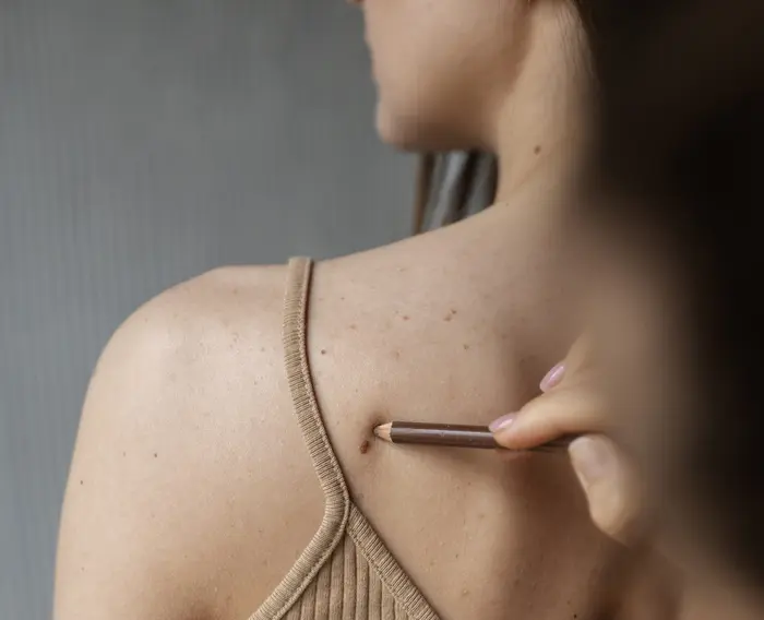 How Does Skin Tag Removal Improve Skin Appearance?