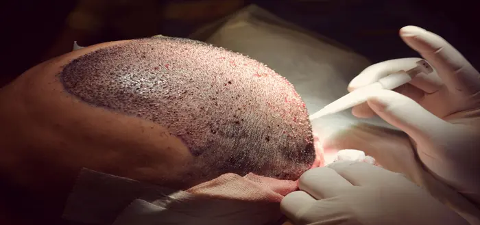 How Is Hair Transplant Cost Calculated for Treatment?