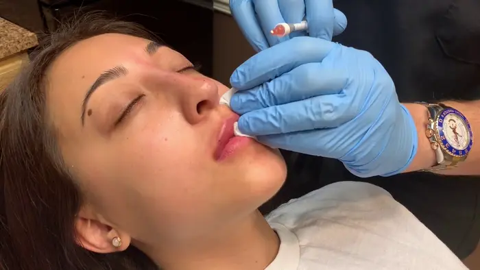 What Should I Consider Before Getting Lip Fillers?