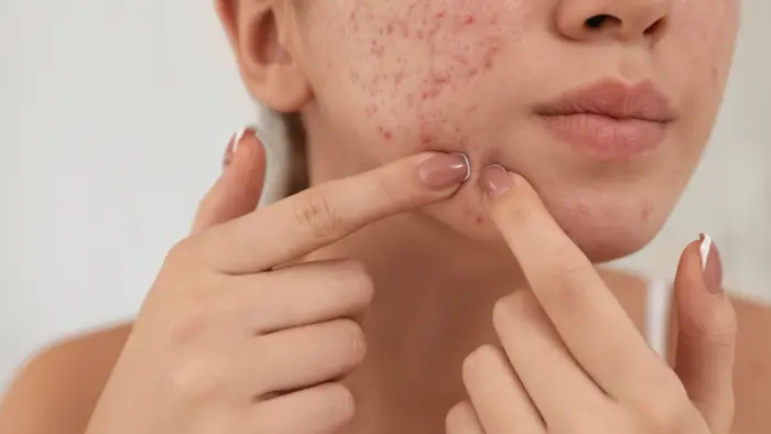 Why Does Pimples Treatment Refine Rough Skin Texture?