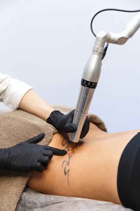 How Does Laser Tattoo Removal Treat Deep Ink Layers?