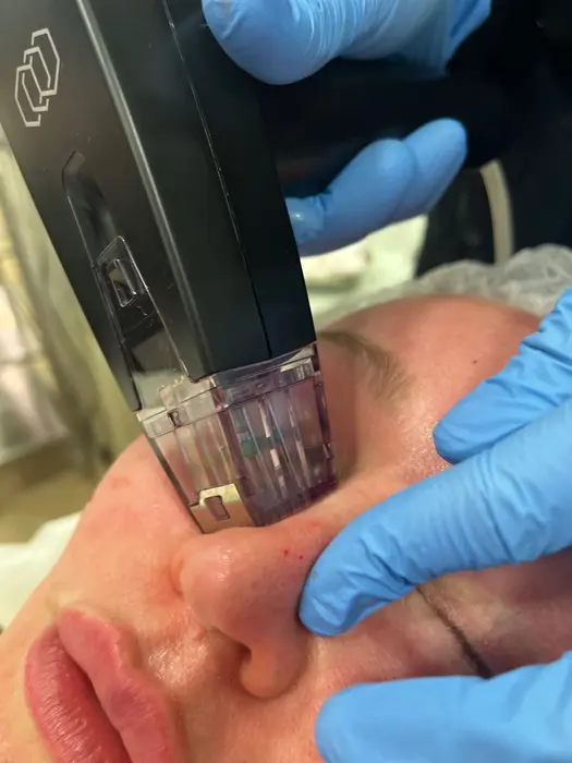 Why Do People Choose Morpheus8 for Skin Renewal?
