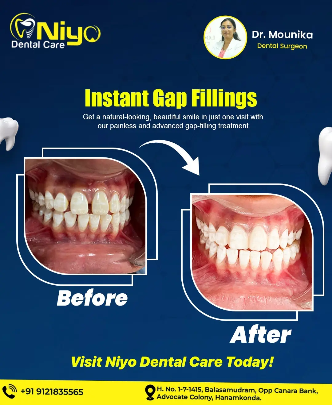 🦷 Say Goodbye to Teeth Gaps Instantly at Niyo Dental Care!