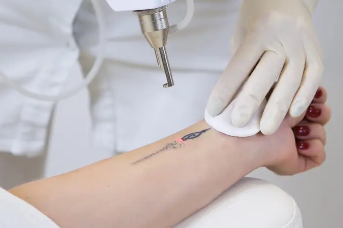 Is Laser Tattoo Removal Safe for Sensitive Skin Areas?