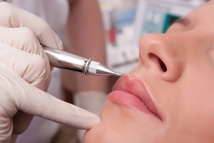 Can Plasma Pen Reduce Mild Skin Laxity Naturally?