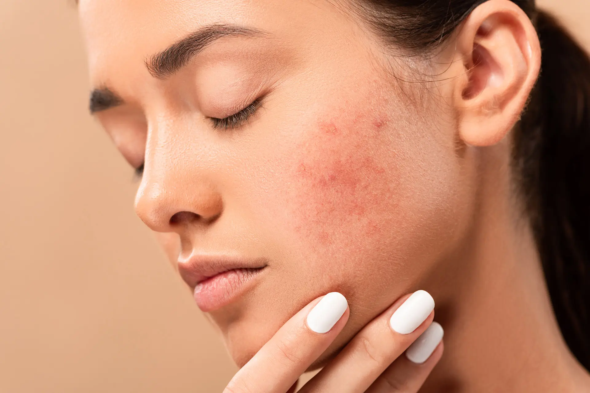 Can Pimples Be Controlled Through Hydration?