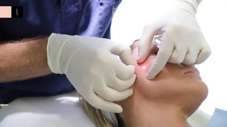 How Does Endolift Treatment Tighten Loose Skin?