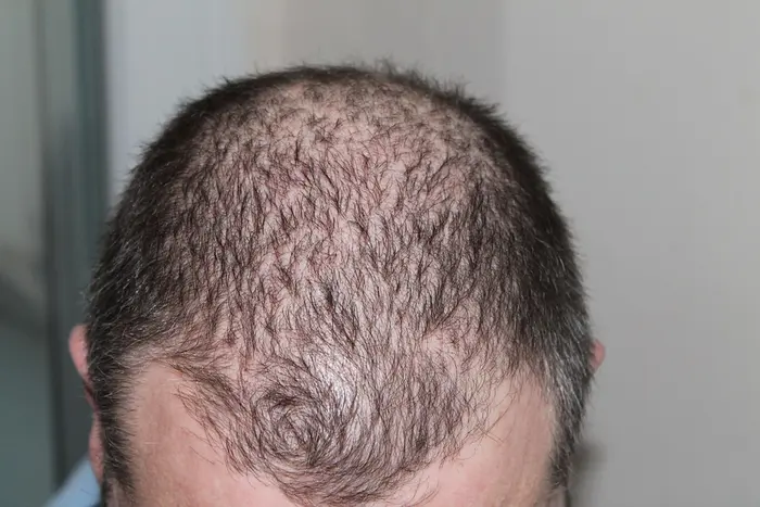 How Does A Crown Hair Transplant Actually Work?