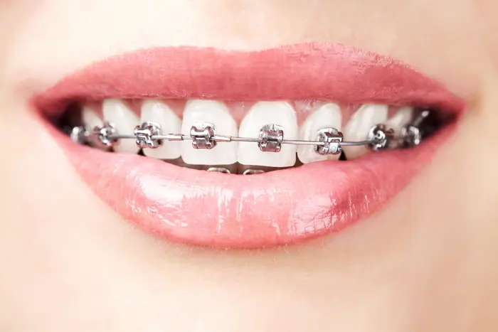 What Age Is Best For Braces Treatment?