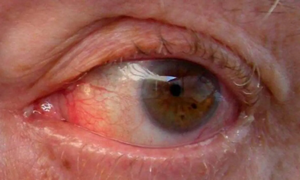 Glaucoma