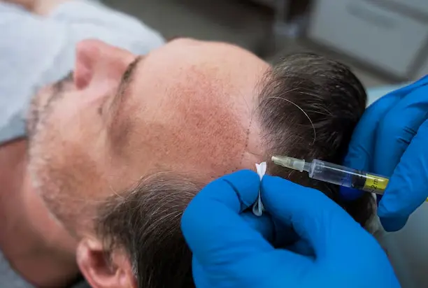 Direct Hair Transplant (DHT)