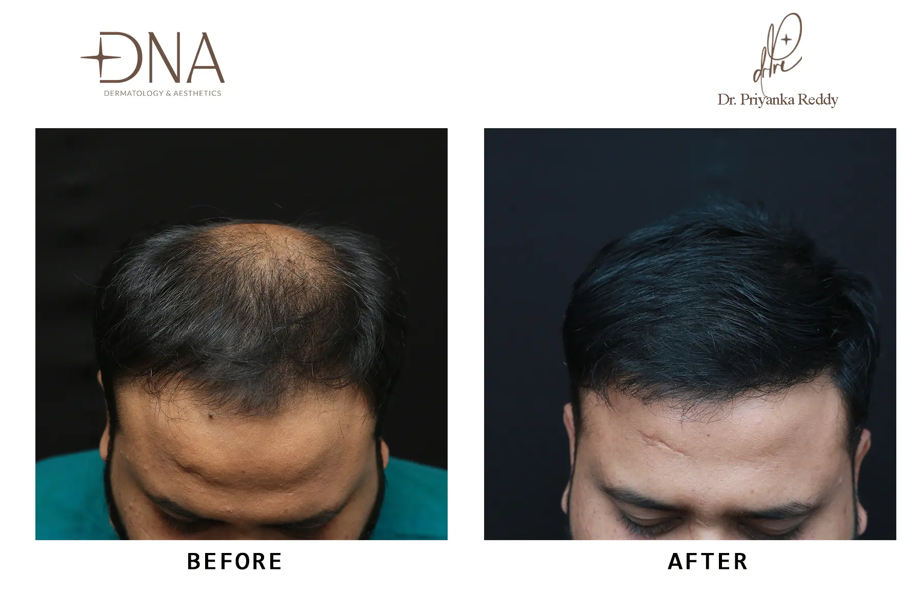  Hair Transplant 