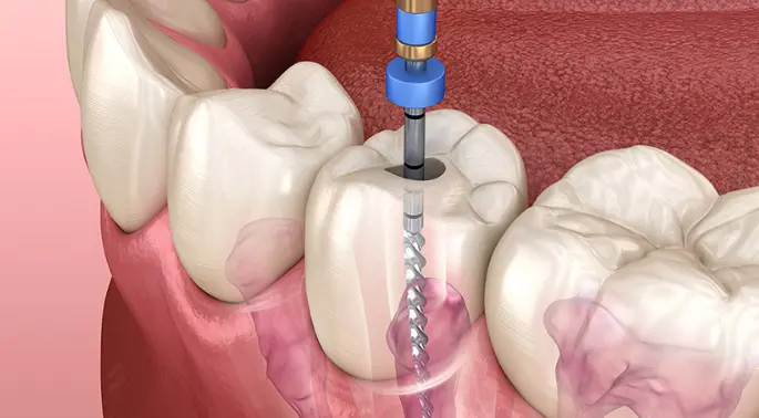 Root Canal Treatment