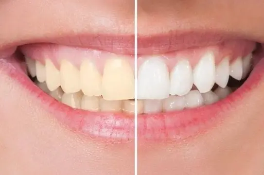 Teeth Whitening