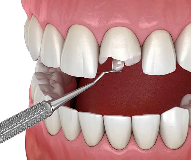 Cleaning and Fillings