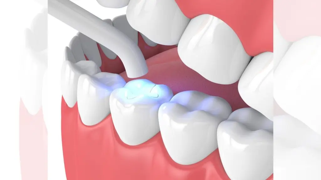 Tooth Coloured Fillings
