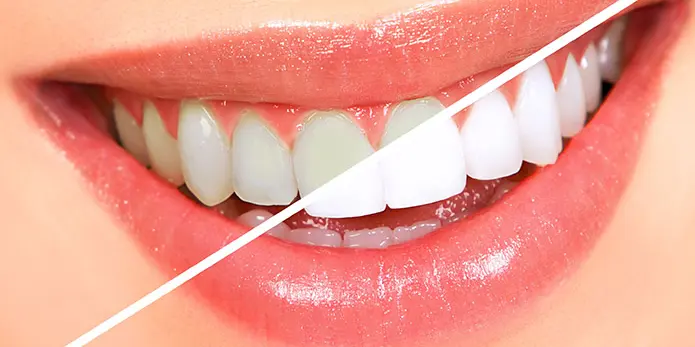 Teeth Whitening