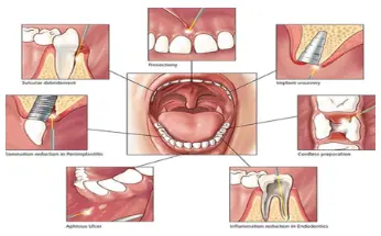 Laser Dentistry