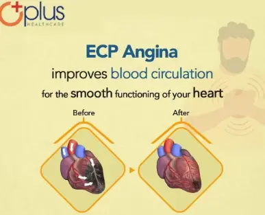 Angina Treatment