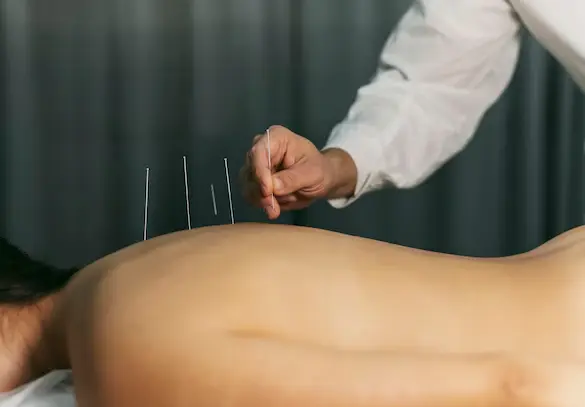 Acupuncture Treatment