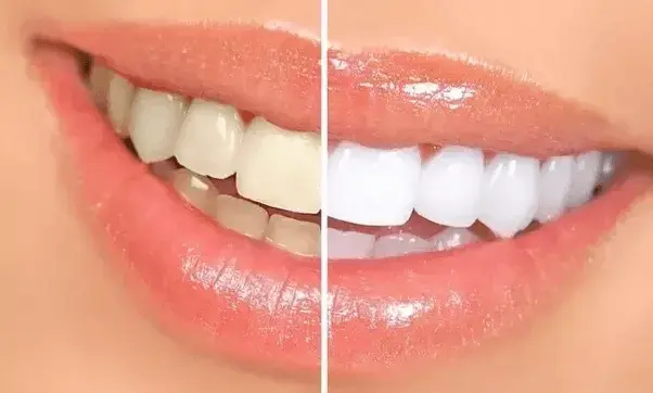 Teeth Whitening