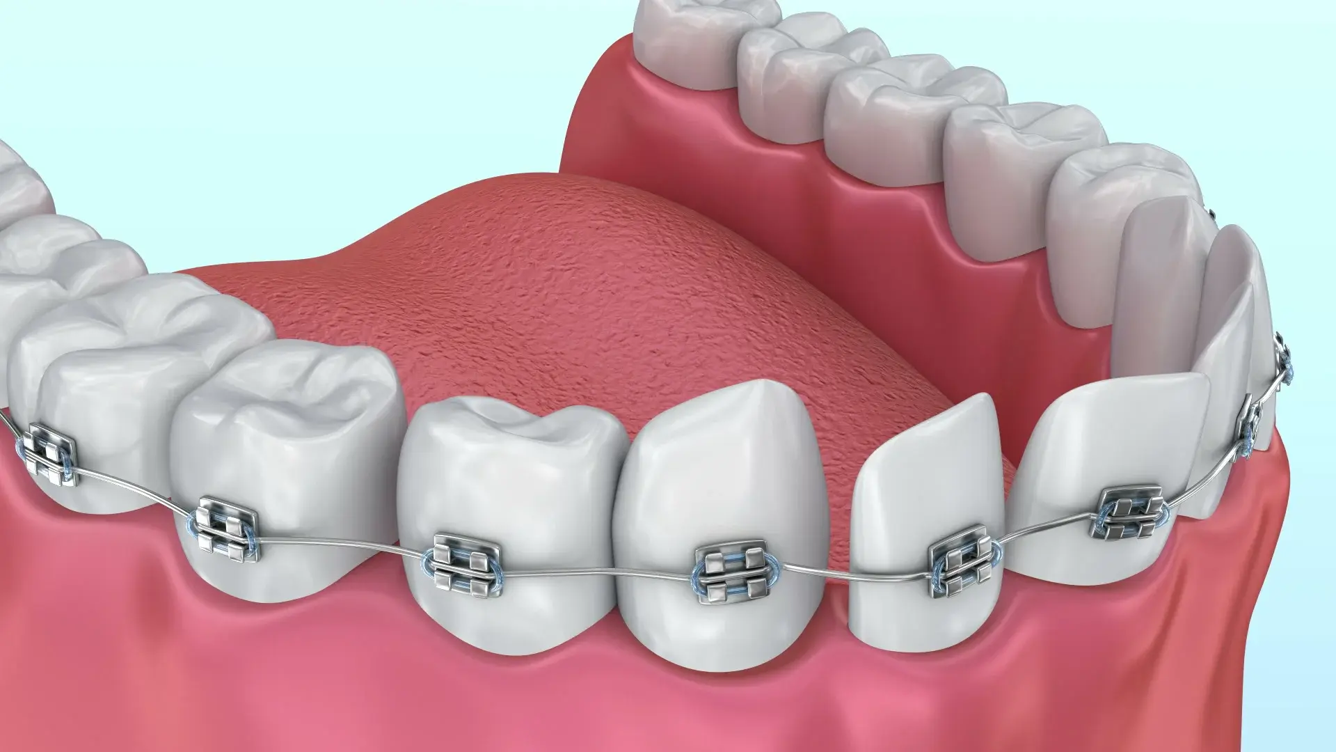 Alignment Teeth Treatment
