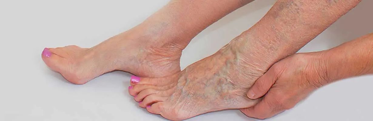 Varicose Vein Laser Treatment