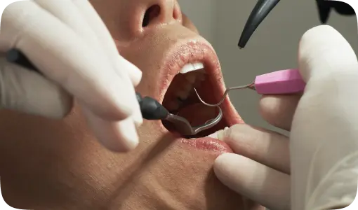 Root Canal