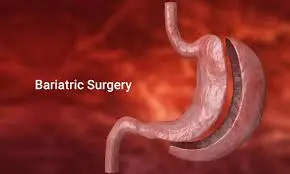 Bariatric Surgery