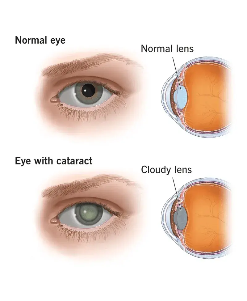 Cataract Surgery