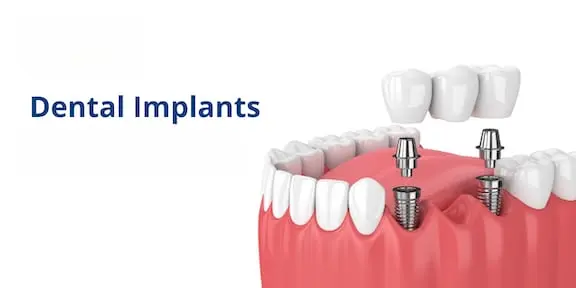 Dental Implants