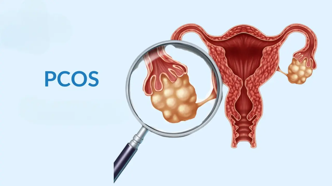 PCOS