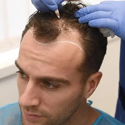 How to Prepare for Your First Hair Transplant Appointment