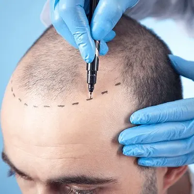 Hair Transplant for Women: Everything You Should Know
