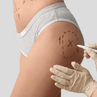 Understanding Fat Survival in Buttock Augmentation in Muscat