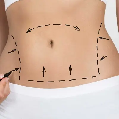 Tummy Tuck After Weight Loss: What to Know
