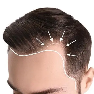 How Hair Transplant Boosts Self-Esteem and Confidence