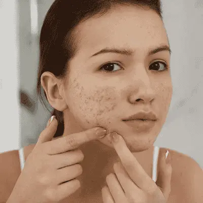 Morning Acne Treatment Routine for Fresher Skin