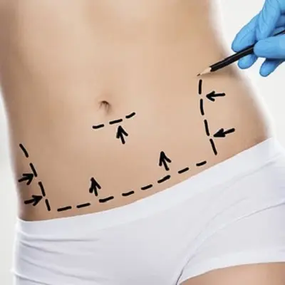 How to Prepare Your Body Mentally for Liposuction