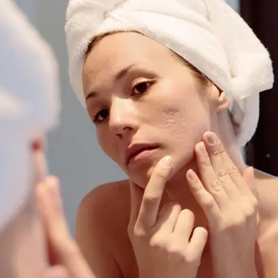 Acne Scar Treatment recovery time: what you need to know