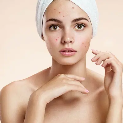 Can Acne Scar Treatment Prevent Future Scarring?