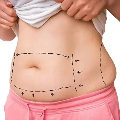 How Liposuction Changes Body Shape Over Tim