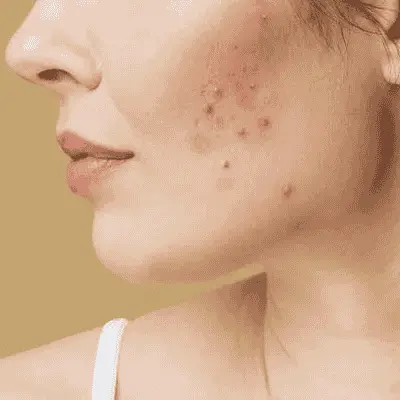 Acne Treatment Options Explained for Beginners