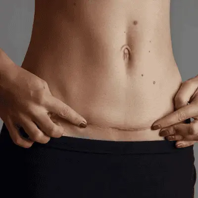 Tummy Tuck Recovery Timeline: What to Expect Week by Week