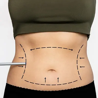 Hidden Benefits of a Tummy Tuck You Might Not Know