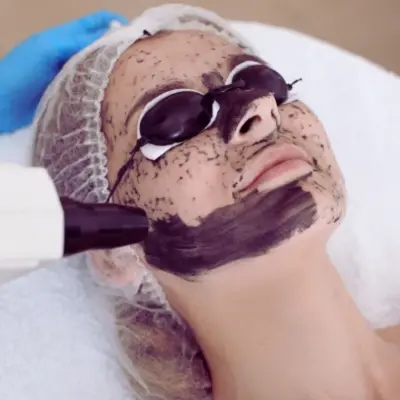 Laser Carbon Peel vs Chemical Peel: Key Differences