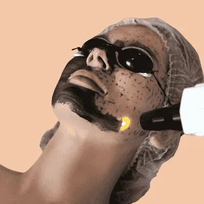 Laser Carbon Peel pros and cons you should know
