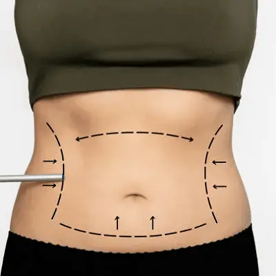 How Long Do Laser Liposuction Results Last?