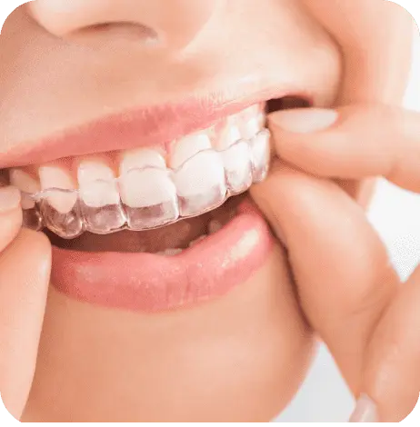 Invisalign