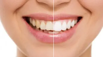 Teeth Whitening